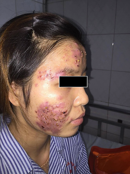 Trứng cá bùng phát trong khi điều trị